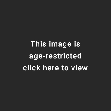 Lap ovarian cystectomy